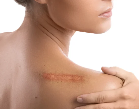 A Scar on a shoulder of a woman