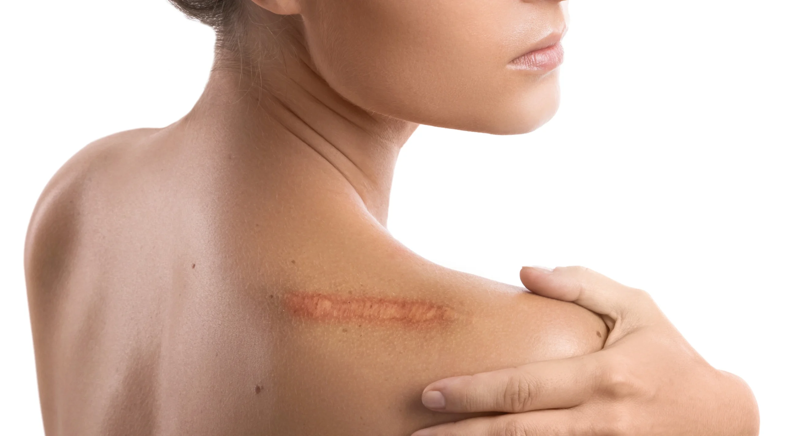 A Scar on a shoulder of a woman