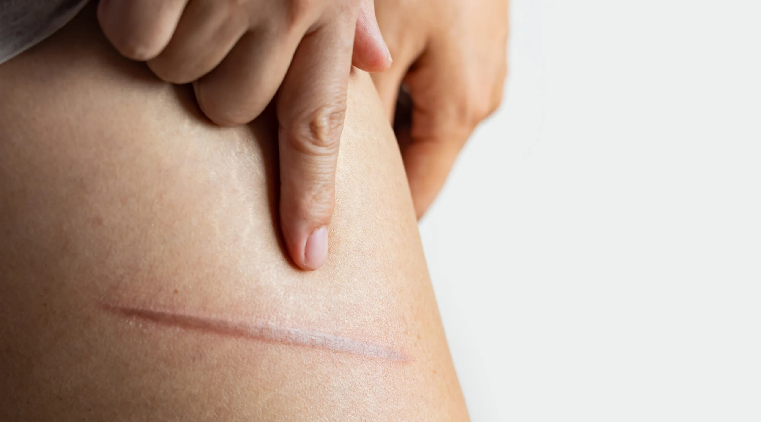female leg with scar