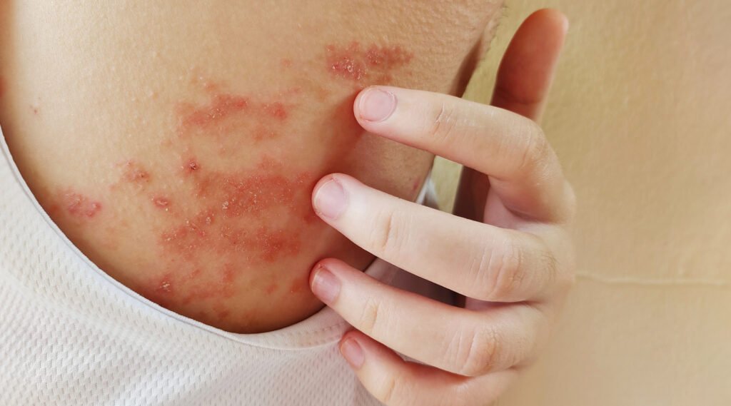 Eczema flare-up skin irritation close-up