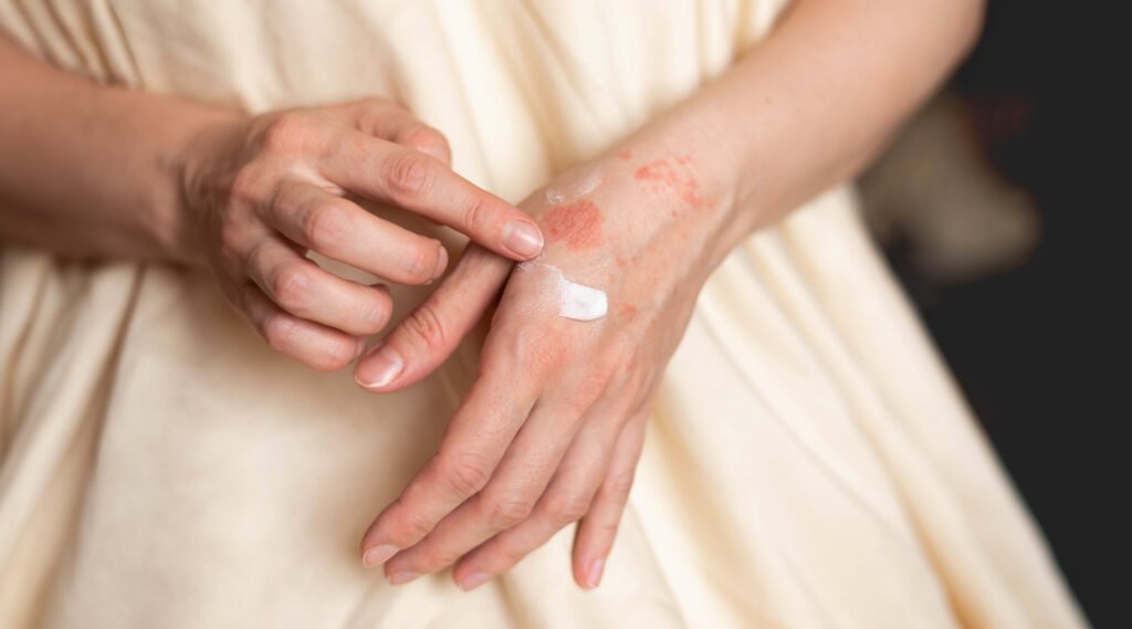 Anti-itch cream application for skin relief