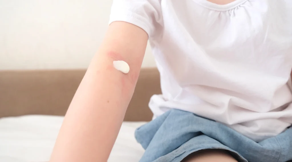 Child with atopic skin soothe with cream