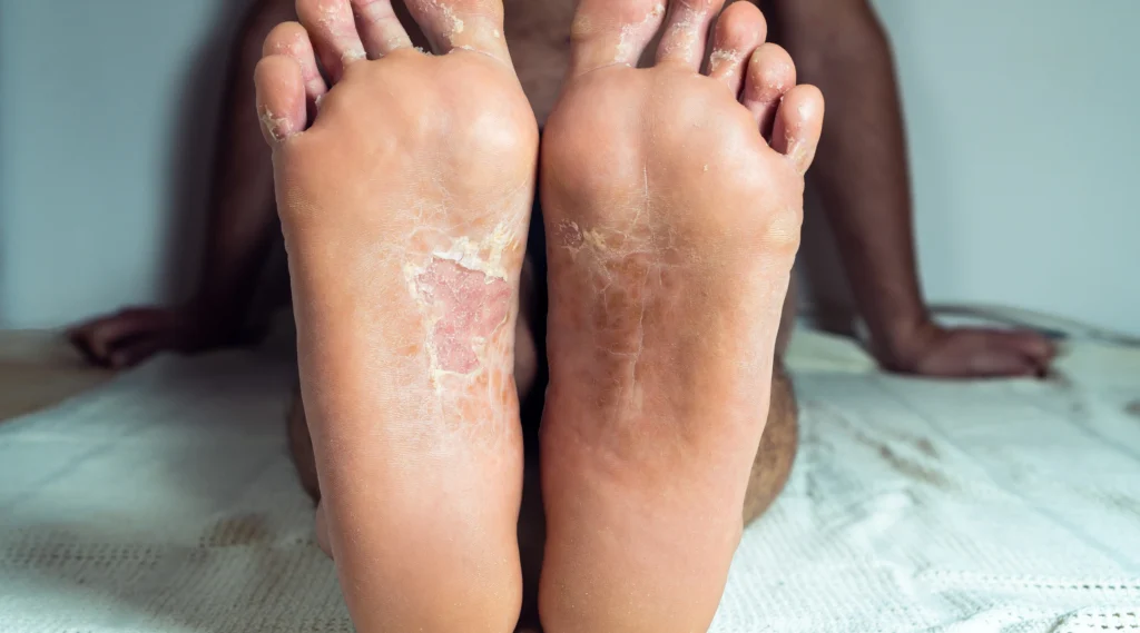 Dry skin on feet