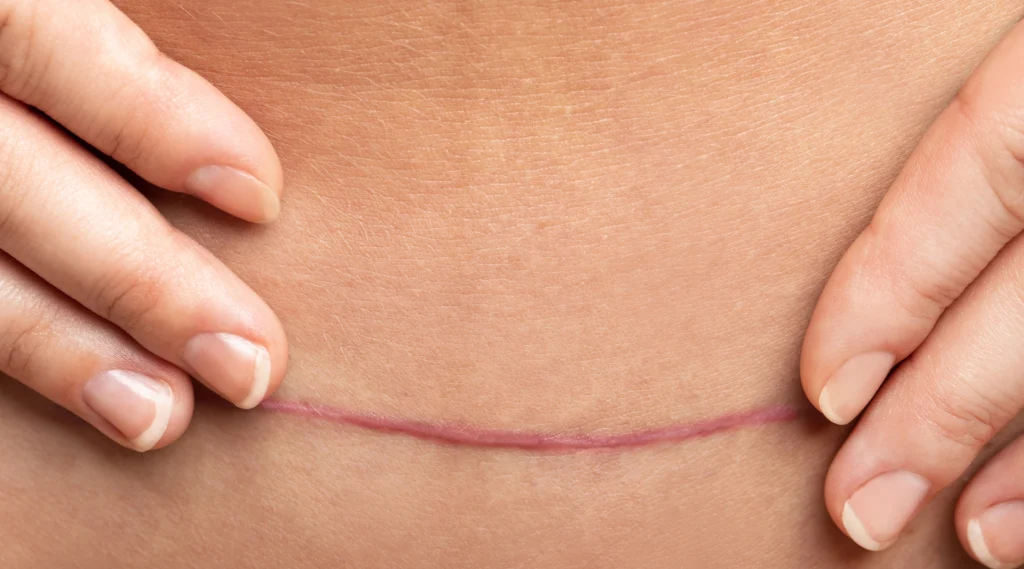 C Section scars in women belly