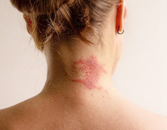 Manifestation atopic dermatitis