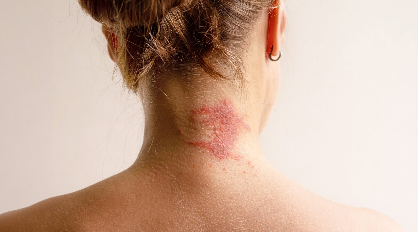 Manifestation atopic dermatitis