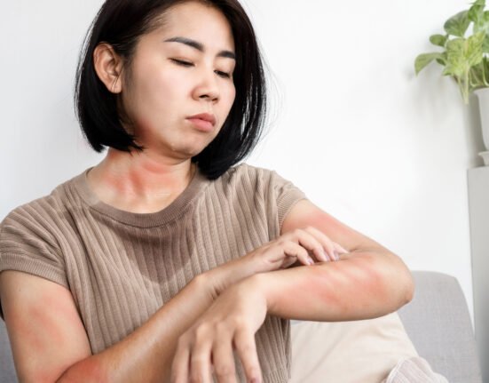 Asian woman has allergic her own.