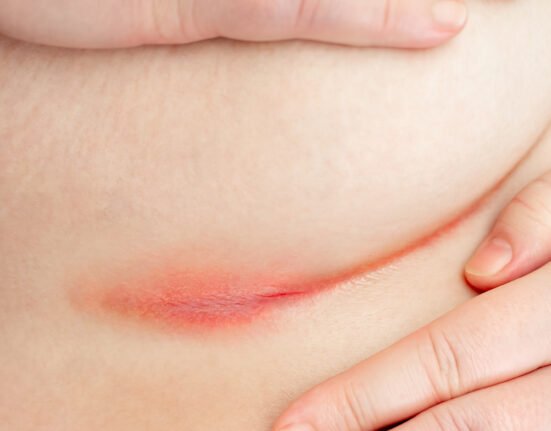 Patient intertrigo shows erythematous rash skin.