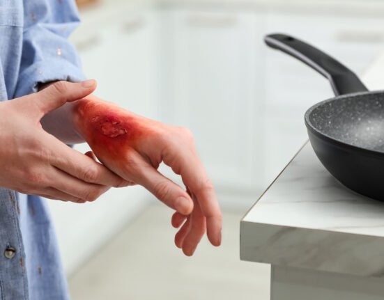 Woman burn on her hand kitchen.