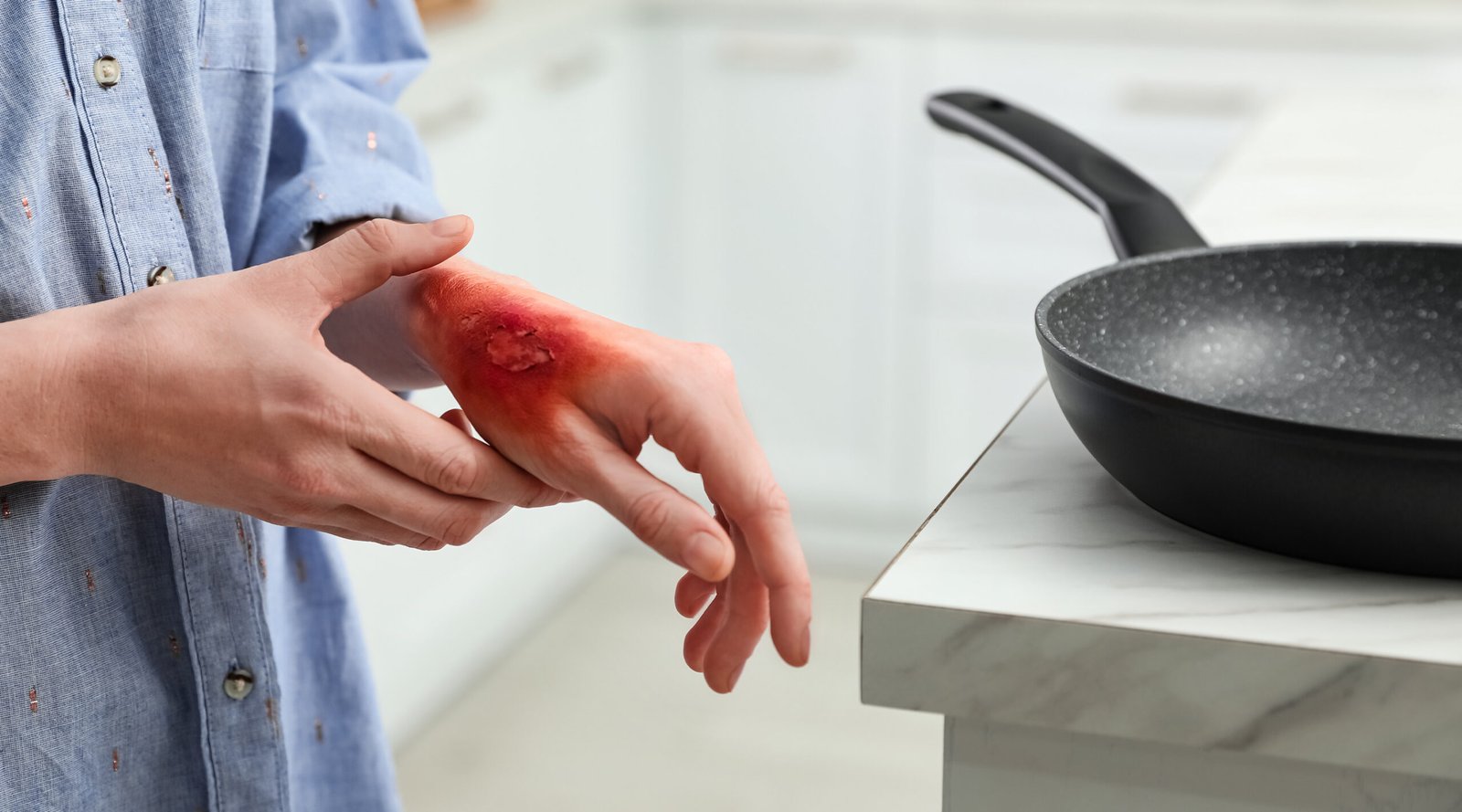 Woman burn on her hand kitchen.