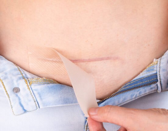 Woman applying patch silicone sheeting on.