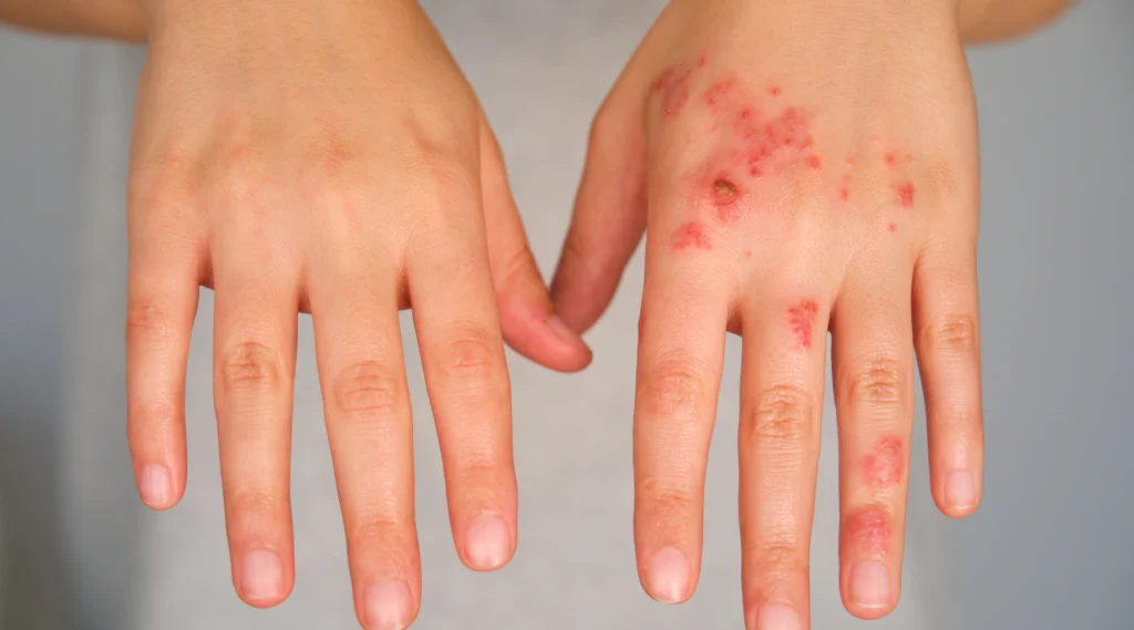 Patient hands with and without eczema comparison