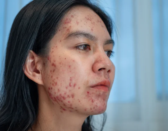 Kulit sensitif banyak bekas jerawat di muka