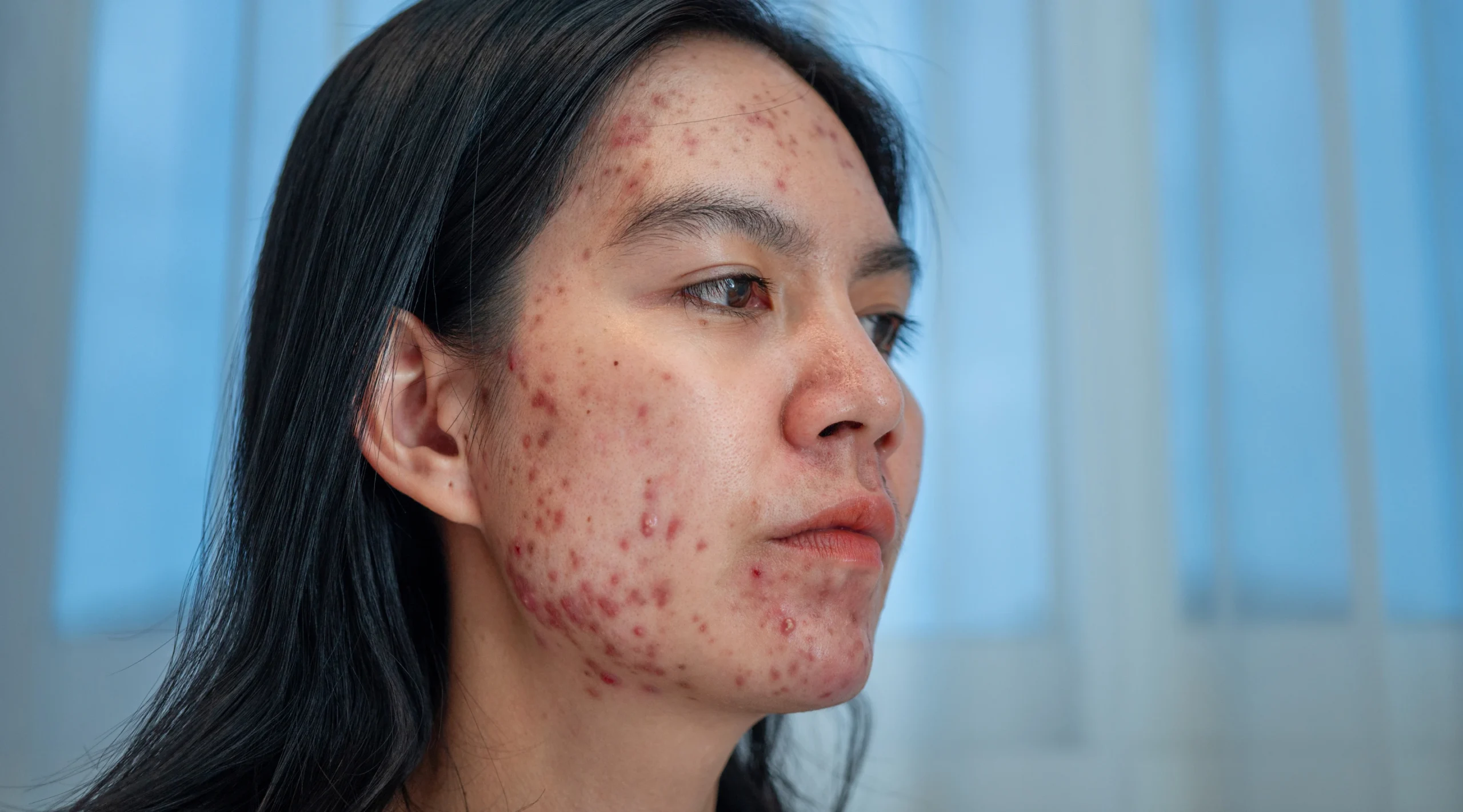 Kulit sensitif banyak bekas jerawat di muka