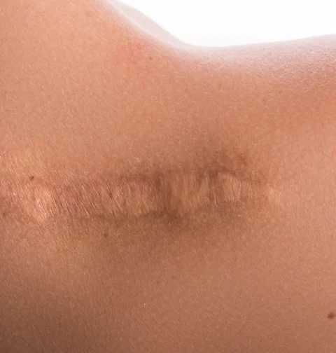 Bekas luka keloid di pundak perempuan