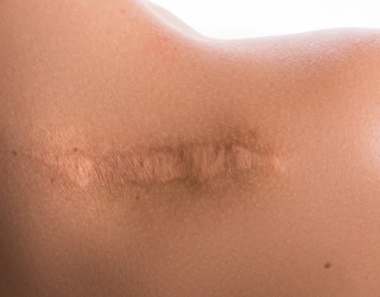 Bekas luka keloid di pundak perempuan