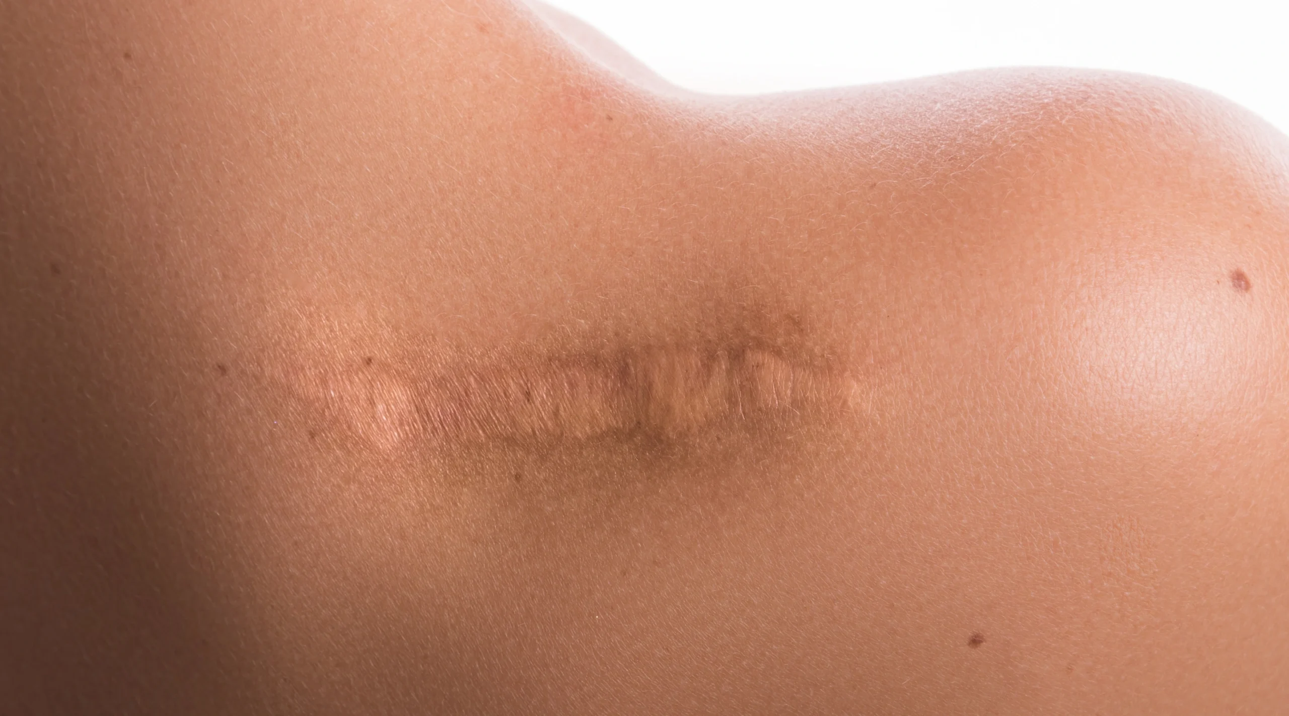 Bekas luka keloid di pundak perempuan