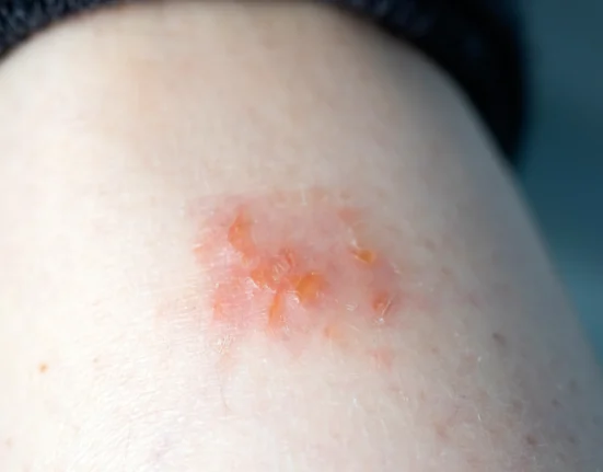 Gambaran dekat kulit atopik dermatitis eksim di kaki