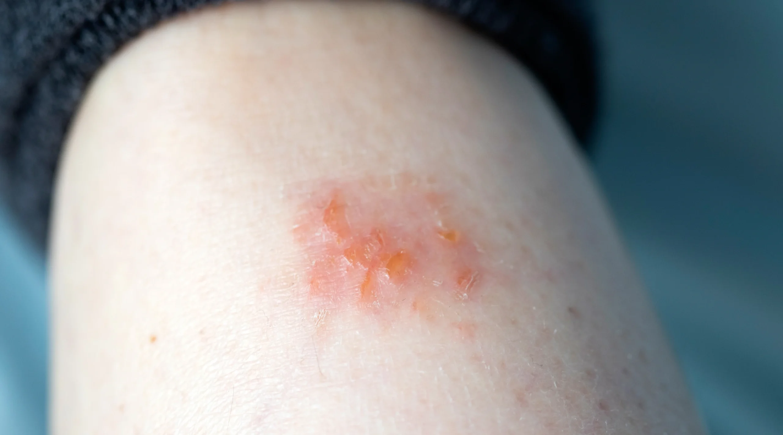 Gambaran dekat kulit atopik dermatitis eksim di kaki