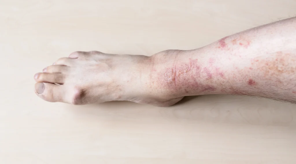 Male shin with itchy red rash on skin
