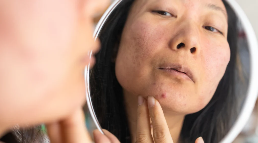 Kulit remaja pubertas sensitive berjerawat
