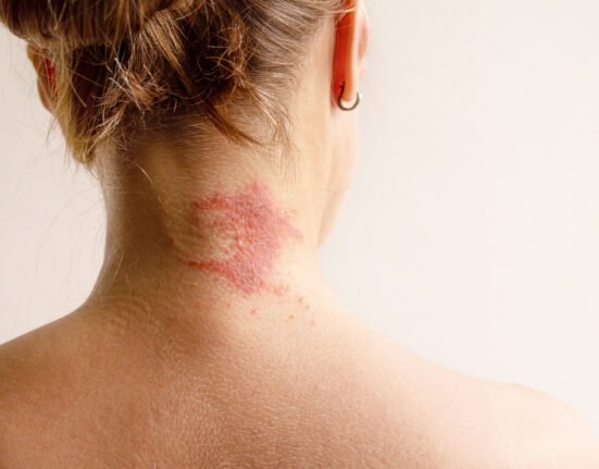 Manifestation atopic dermatitis red itchy spot.