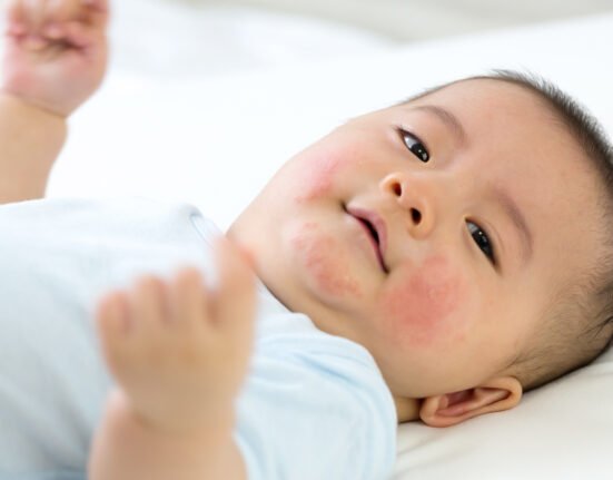Baby has allergic reaction face skin.