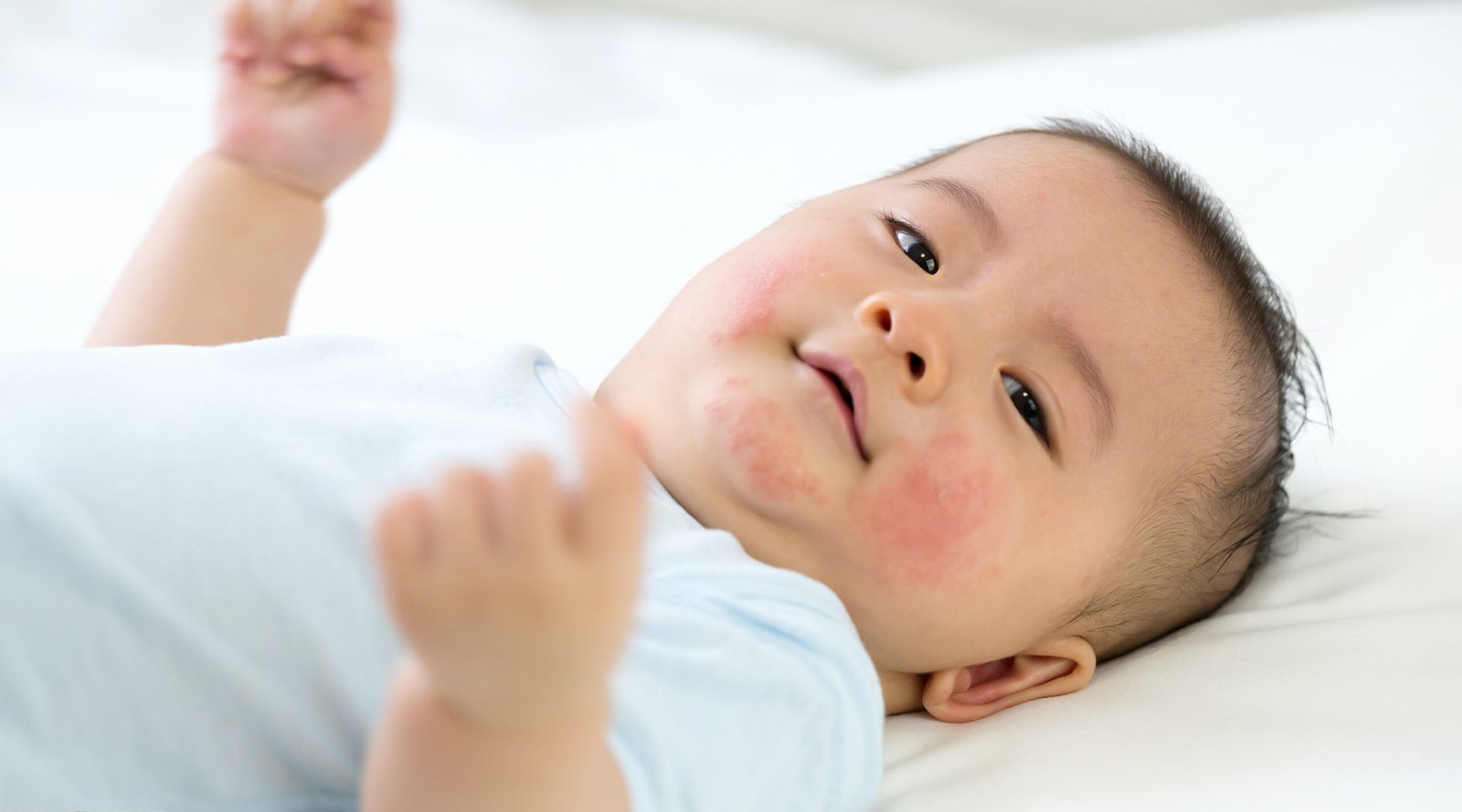 Baby has allergic reaction face skin.