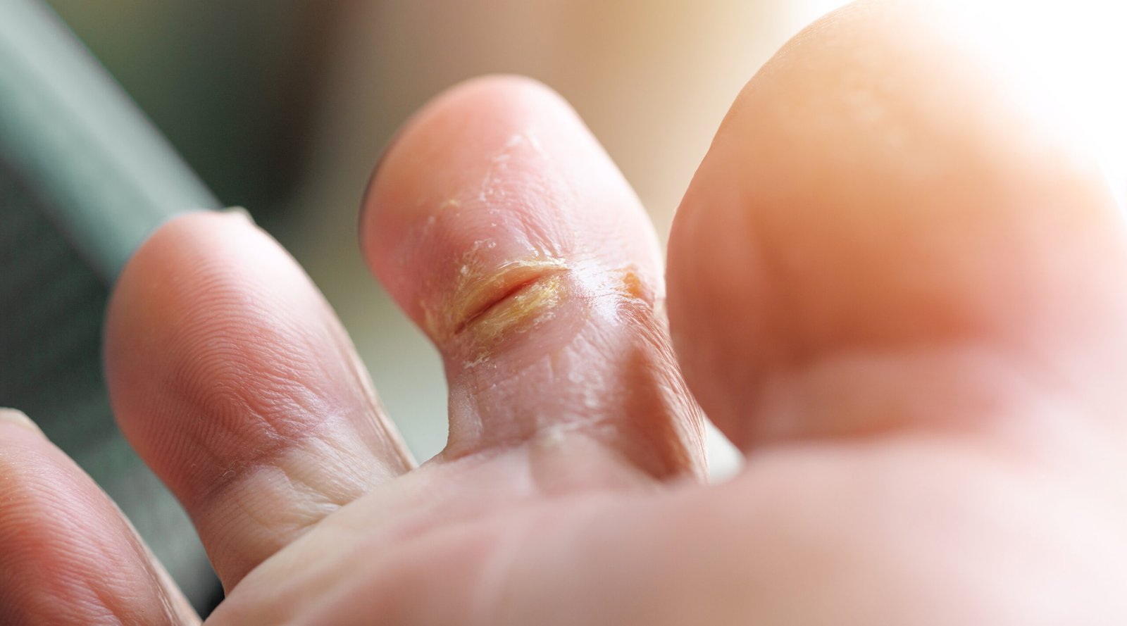 Dry cracked toe wounds infection wet.