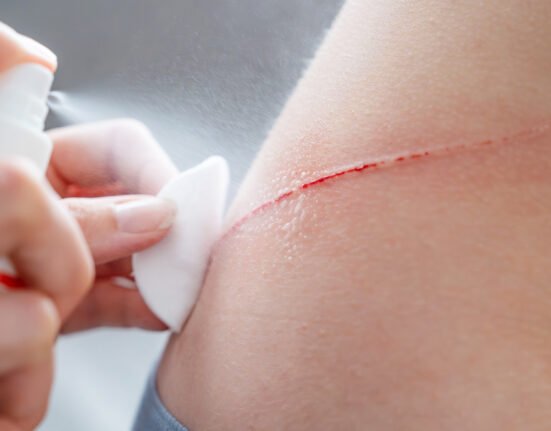 Spray antiseptic om wound child backs