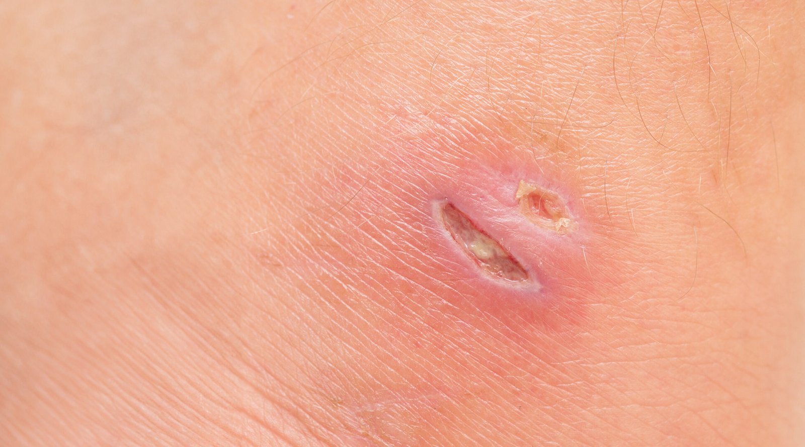 Wound on human skin.