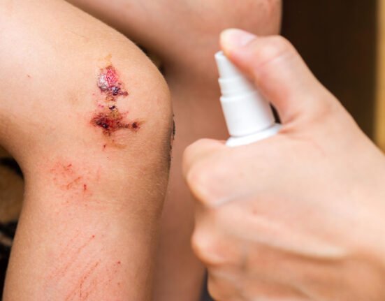 Woman sprays antiseptic agent on wound