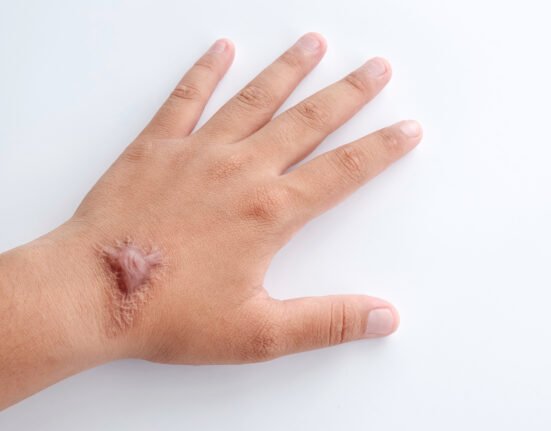 Hypertrophic keloid scar on hand