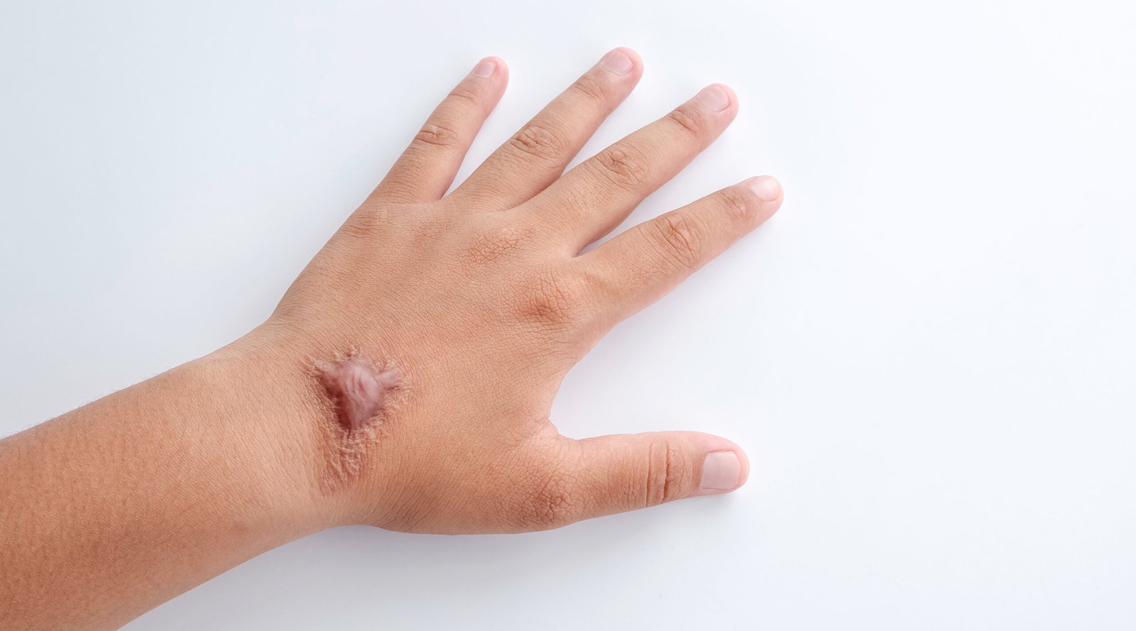 Hypertrophic keloid scar on hand