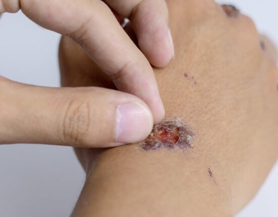 Wound inflicted falling motorcycle dragged along.
