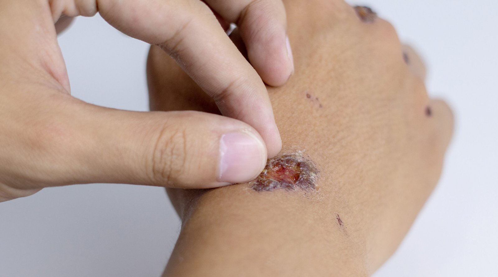Wound inflicted falling motorcycle dragged along.