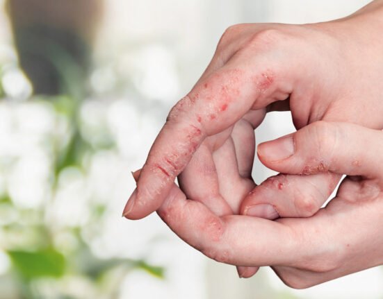 Psioriasis skin on woman hands peeling.
