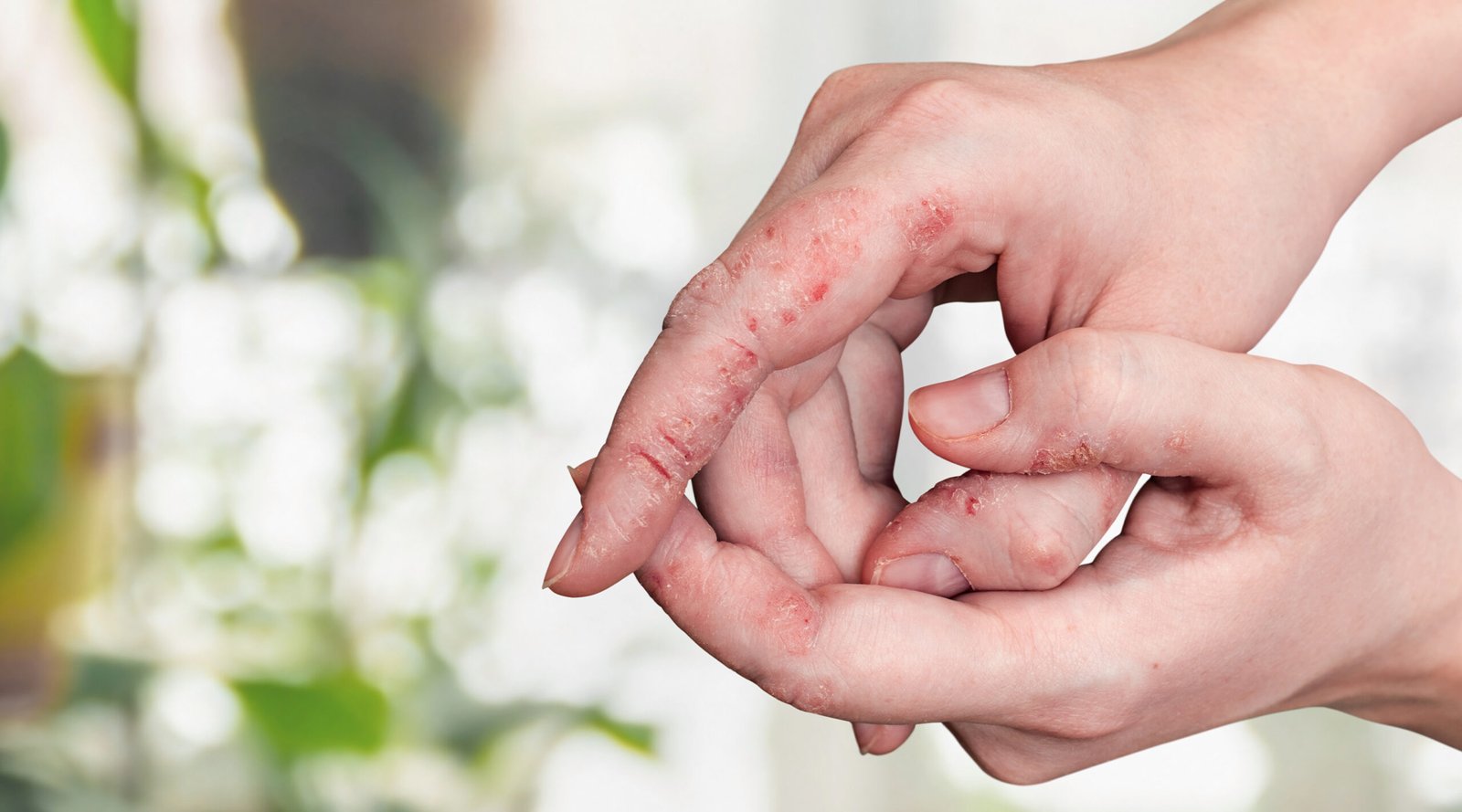 Psioriasis skin on woman hands peeling.