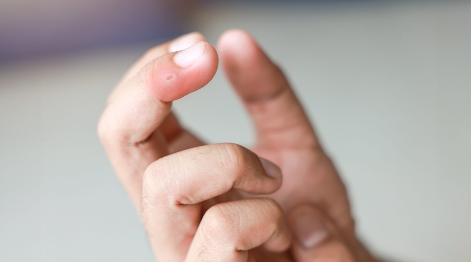 Young man injured his finger swollen.
