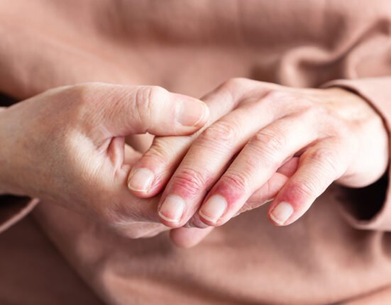 Woman hands atopic dermatitis eczema allergic
