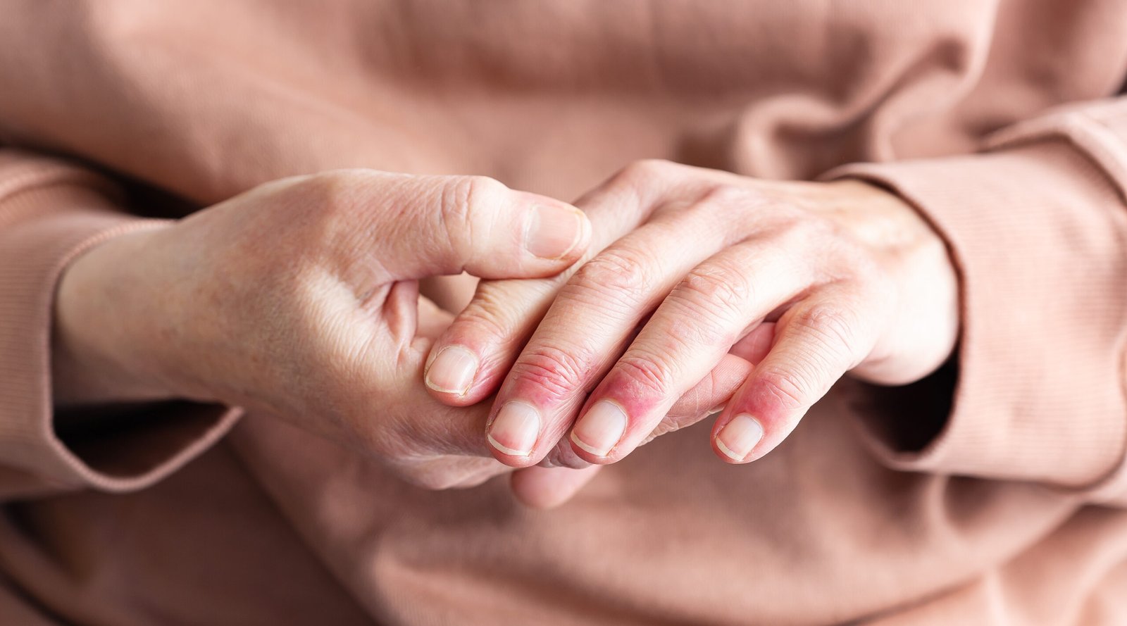 Woman hands atopic dermatitis eczema allergic