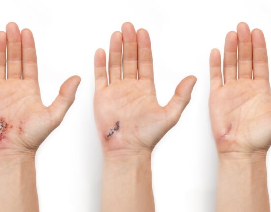 Wound healing visualitation hand lateration stitches.