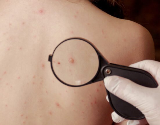 Chickenpox measles close naked body