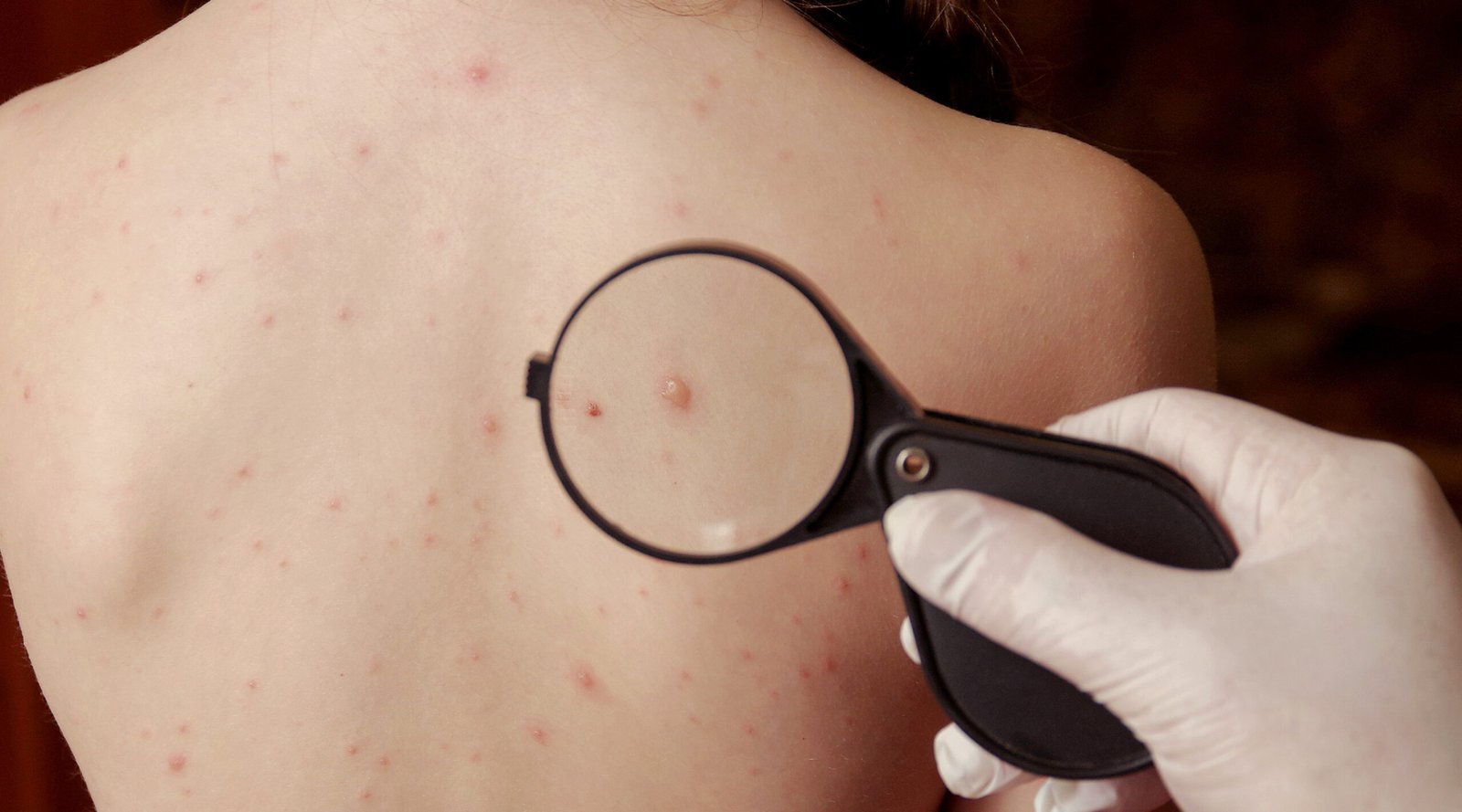Chickenpox measles close naked body