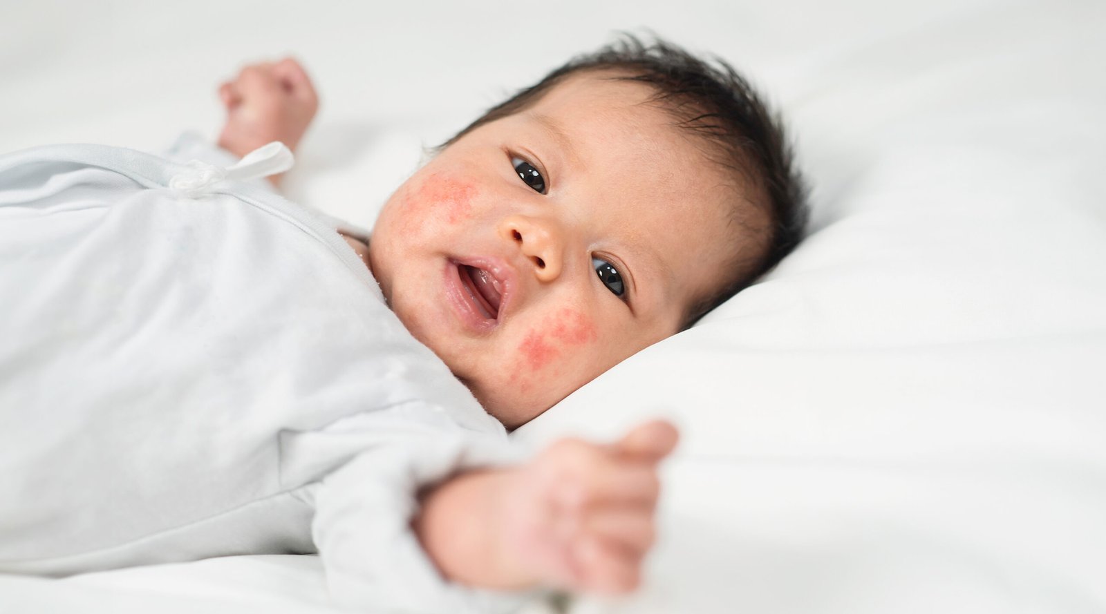 New born baby skin rashes on