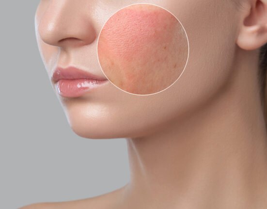 Young girl problem skin photo before