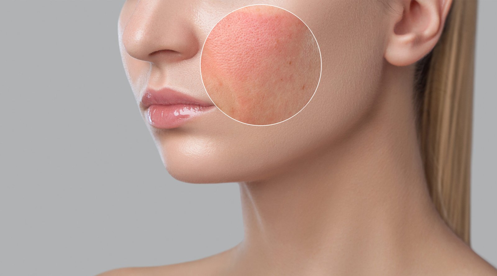 Young girl problem skin photo before