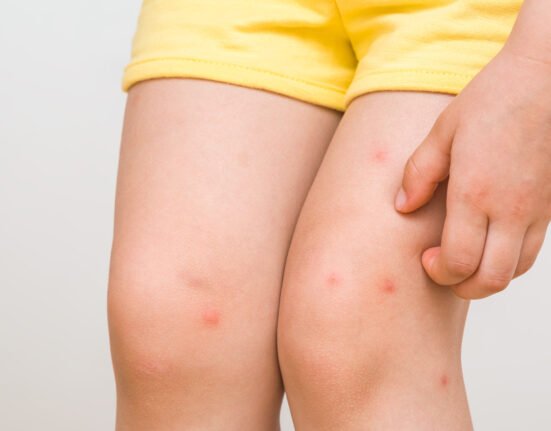 Little Asian girl has allergies mosquitoes
