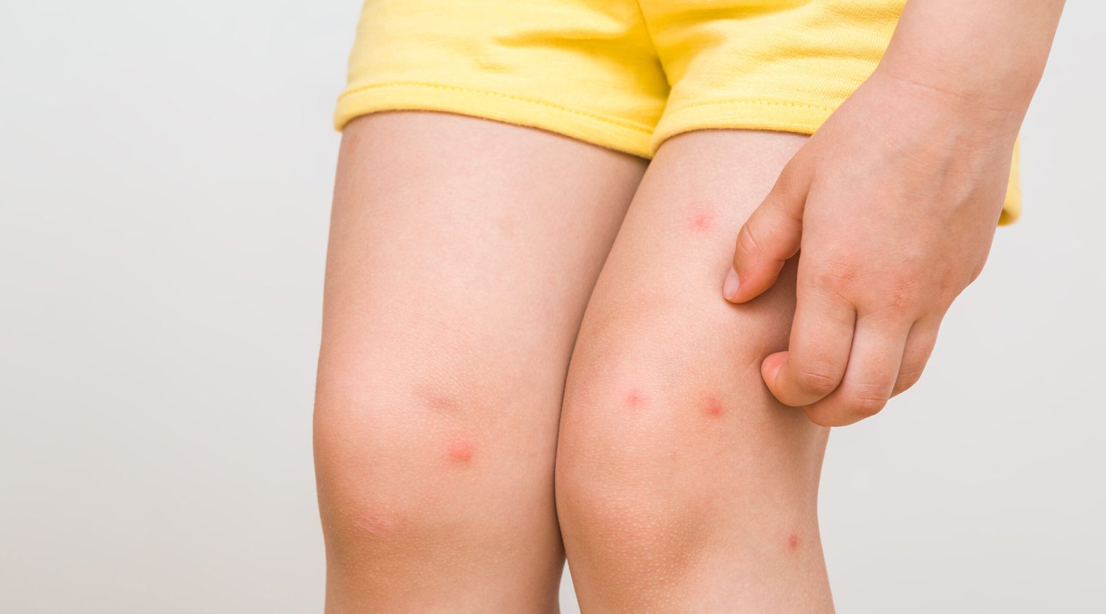 Little Asian girl has allergies mosquitoes