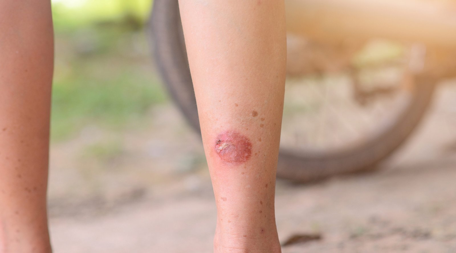 Burn wound right leg motorcycle exhaust